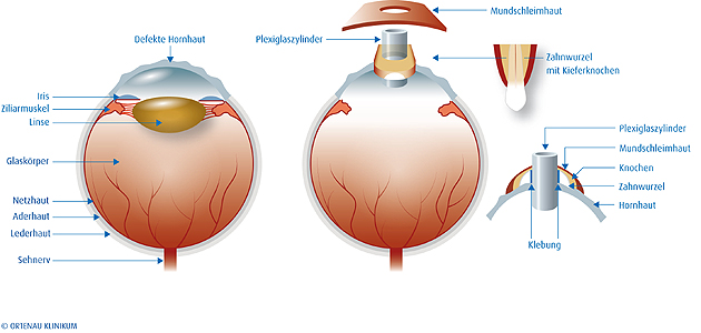 ok_augenklinik_schaubild keratoprothese