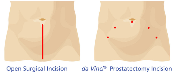 vergleich-prostatektomie