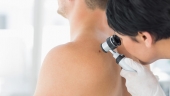 Gut erkannt: Die ABCDE-Regel bei Hautkrebs