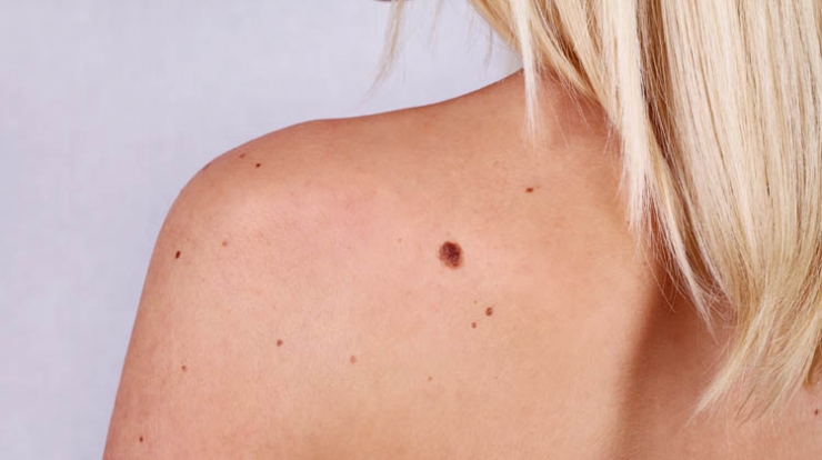 Die Hautkrebs-App Skinvision – Fragen an einen Dermatologen