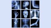 Bildgebende Verfahren: Wie funktioniert Röntgen?