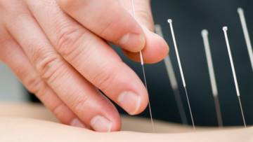 Akupunktur kein Placebo-Effekt 