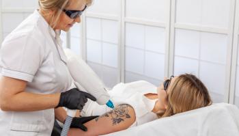 Laserbehandlung: Tattoo-Entfernung mittels Laser