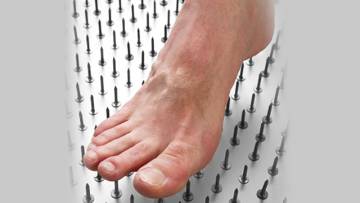 Wie ein Nagel in der Fußsohle – Der Fersensporn