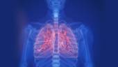 Was ist eine idiopathische Lungenfibrose?