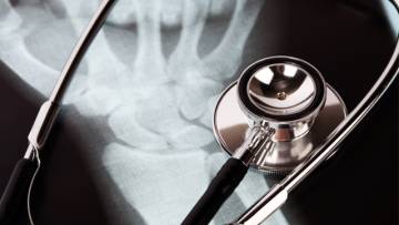 Wenn der Knochen schwindet – Osteoporose und seine Behandlung